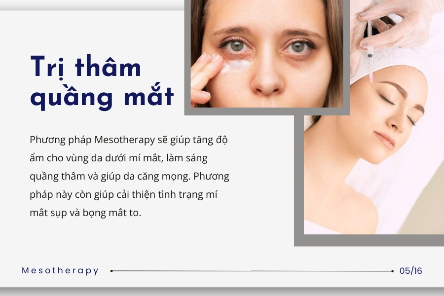 Dùng phương pháp Mesotherapy trị thâm quầng mắt Dùng phương pháp Mesotherapy trị thâm quầng mắt