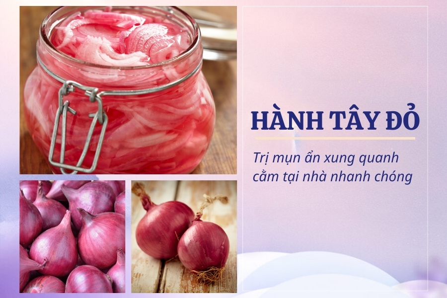 Hành tây đỏ chứa nhiều dưỡng chất có khả năng tiêu diệt các tế bào mụn ẩn quanh cằm Hành tây đỏ chứa nhiều dưỡng chất có khả năng tiêu diệt các tế bào mụn ẩn quanh cằm
