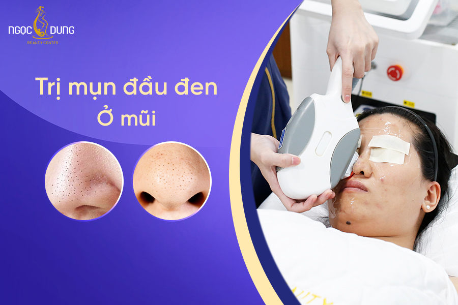 Tổng hợp 13 cách trị mụn đầu đen ở mũi, se khít lỗ chân lông