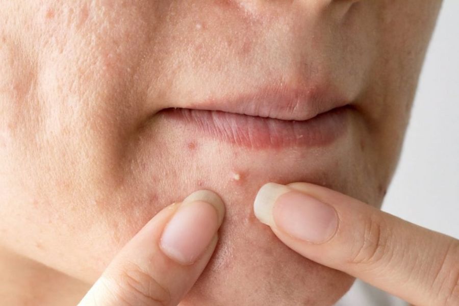 Mụn đầu trắng là một loại mụn trứng cá, phát triển do sự tích tụ tế bào da chết kéo dài Mụn đầu trắng là một loại mụn trứng cá, phát triển do sự tích tụ tế bào da chết kéo dài