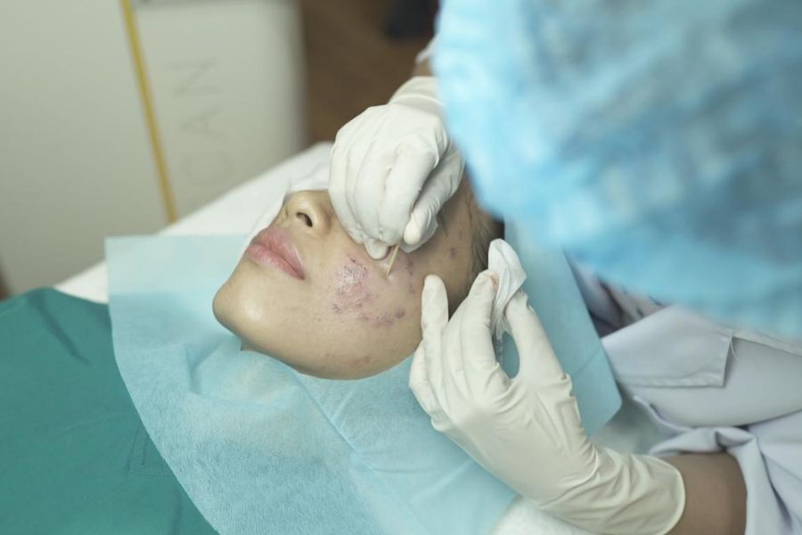 Trị sẹo rỗ bao nhiêu tiền? Chi phí thực hiện sẽ phụ thuộc vào kỹ thuật mà bạn lựa chọn