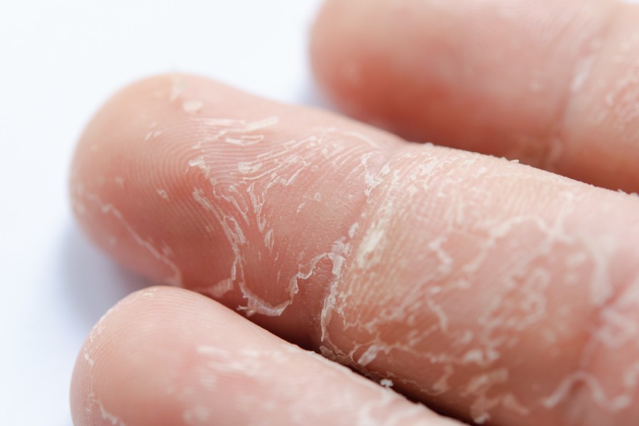 Tình trạng đầu ngón tay bị tróc da có thể là dấu hiệu của bệnh Exfoliative Keratolysis
