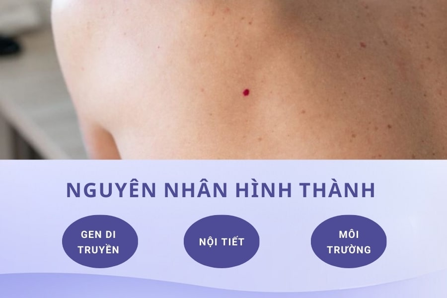 Nguyên nhân hình thành các mụn ruồi son là gì? Nguyên nhân hình thành các mụn ruồi son là gì?