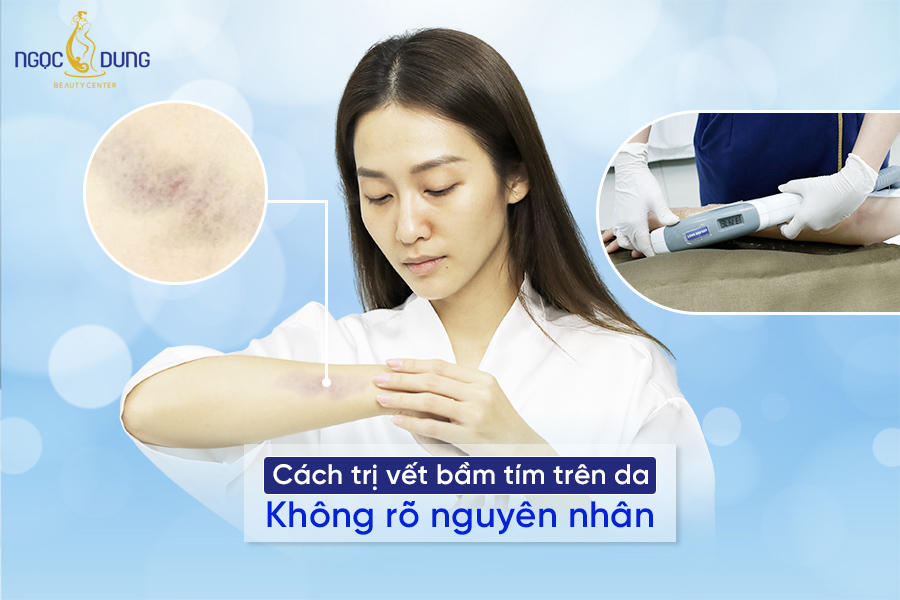 vết bầm tím trên da không rõ nguyên nhân