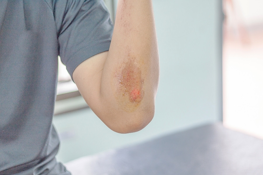 Vết thương bị tác động khi lên da non sẽ để lại thâm