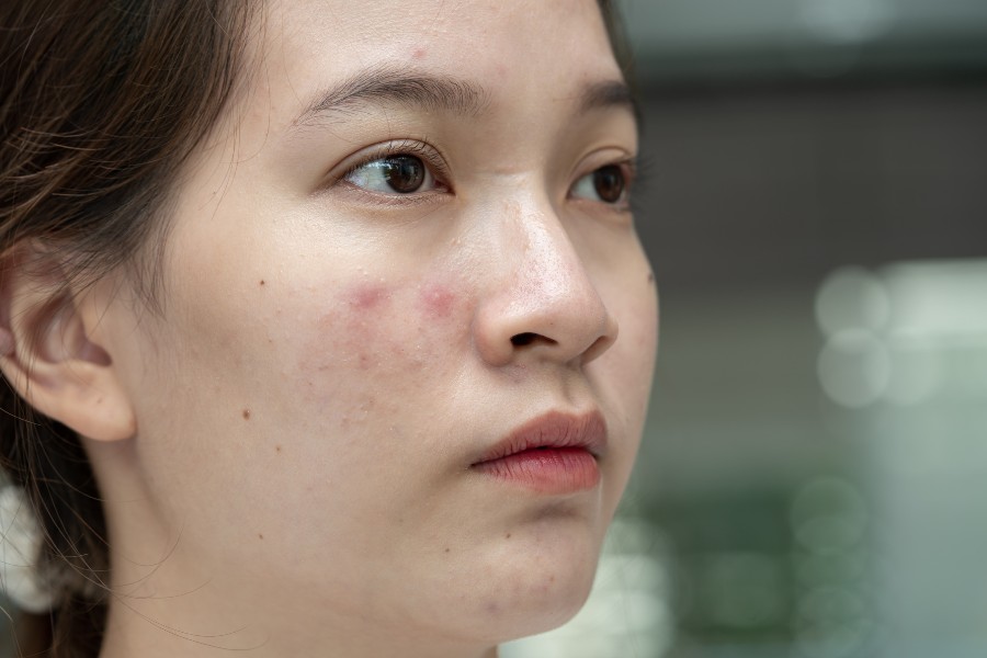 Vùng chữ T trên mặt là nơi thường xuyên tiết dầu nhờn, bị viêm mụn Vùng chữ T trên mặt là nơi thường xuyên tiết dầu nhờn, bị viêm mụn