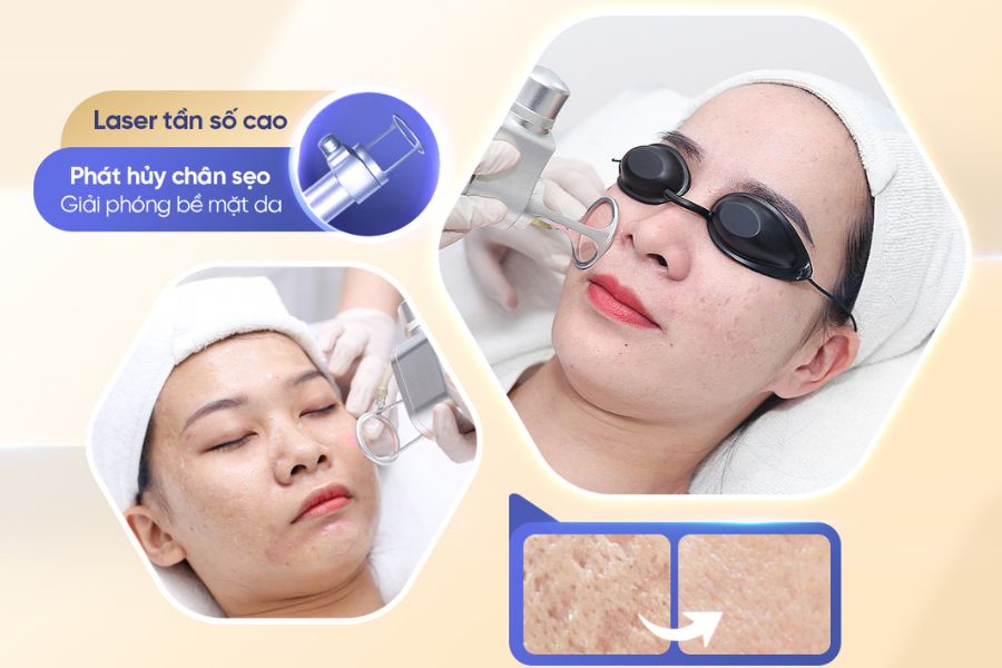 Công nghệ điều trị sẹo rỗ ưu việt giúp mang đến cho bạn làn da mịn màng, trắng sáng