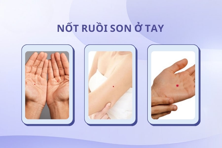 Mụn ruồi son ở tay - Hứa hẹn sự thịnh vượng, giàu có Mụn ruồi son ở tay - Hứa hẹn sự thịnh vượng, giàu có