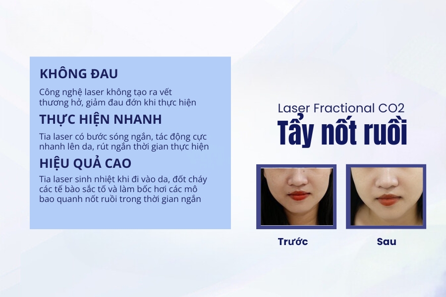 Nốt ruồi ngón tay út - Phúc khí đầy kho?
