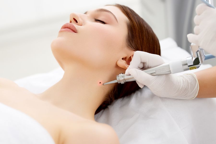 Tẩy nốt ruồi bằng laser giúp mang lại hiệu quả nhanh chóng, không gây ra cảm giác đau rát, khó chịu