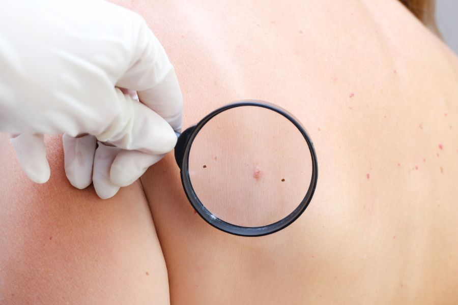 Có nên tẩy xóa nốt ruồi hay không hoàn toàn phụ thuộc vào quyết định cá nhân của bạn