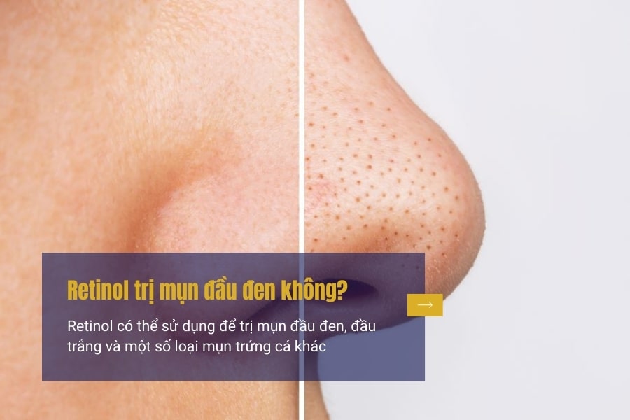 Retinol có trị mụn đầu đen không? Retinol có trị mụn ẩn không?