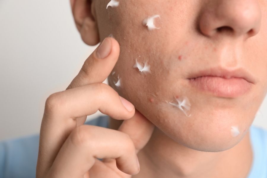 Dùng thuốc bôi đã được kê đơn để điều trị viêm nang lông tại nhà