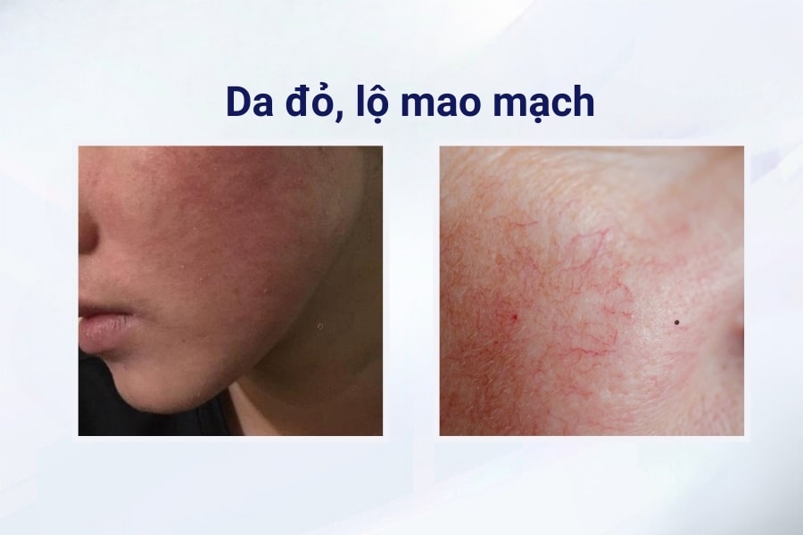 Những tác hại và biến chứng khôn lường sau khi trị mụn bằng thuốc rượu Những tác hại và biến chứng khôn lường sau khi trị mụn bằng thuốc rượu