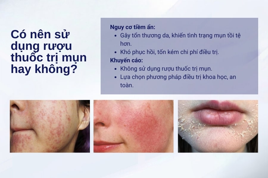 Có nên dùng thuốc rượu trị mụn hay không và lý do vì sao? Có nên dùng thuốc rượu trị mụn hay không và lý do vì sao?