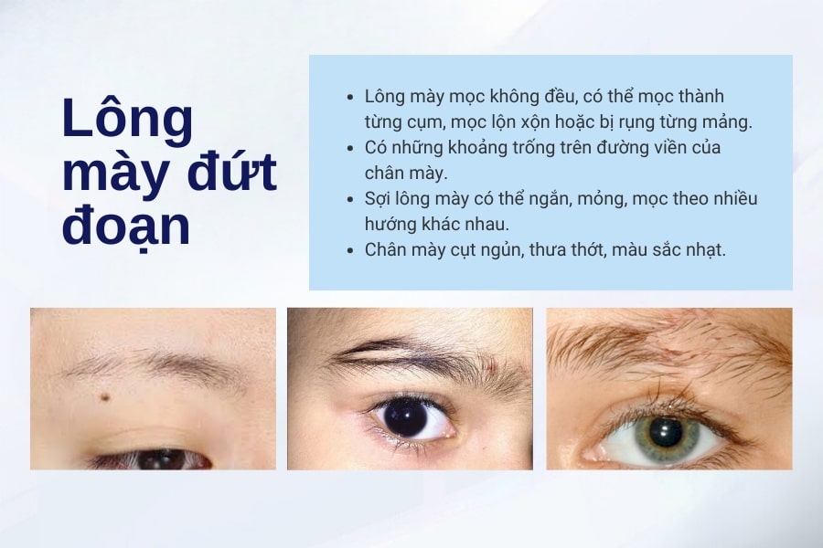 Thế nào là lông mày đứt đoạn? Thế nào là lông mày đứt đoạn?