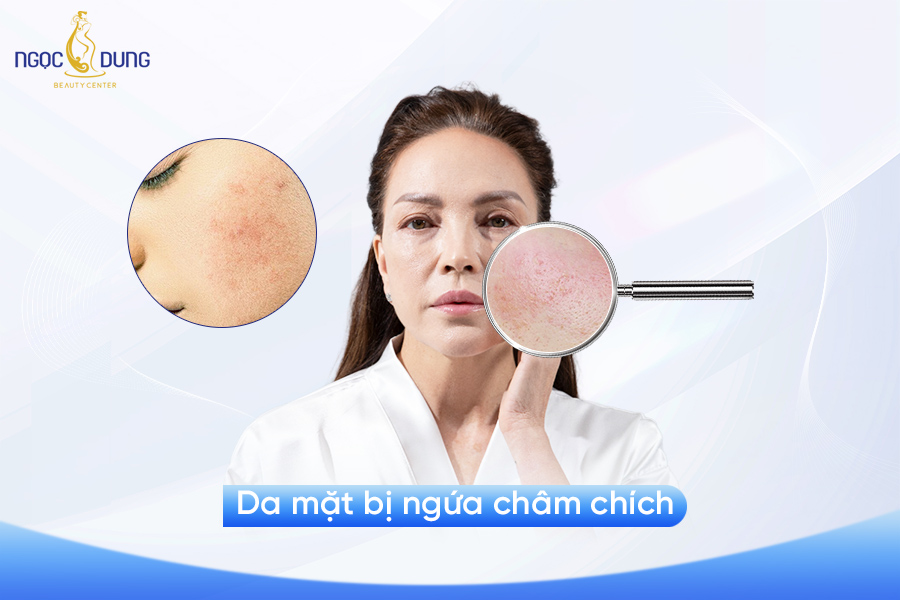 da mặt bị ngứa châm chích