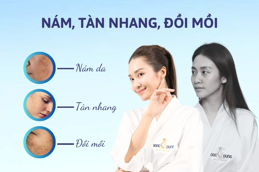 Nám tàn nhang đồi mồi là những bệnh lý về da thường gặp Nám tàn nhang đồi mồi là những bệnh lý về da thường gặp