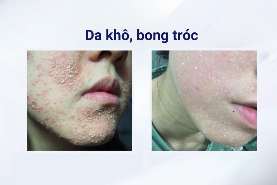Dùng rượu thuốc trị mụn có tốt không? Dùng rượu thuốc trị mụn có tốt không?