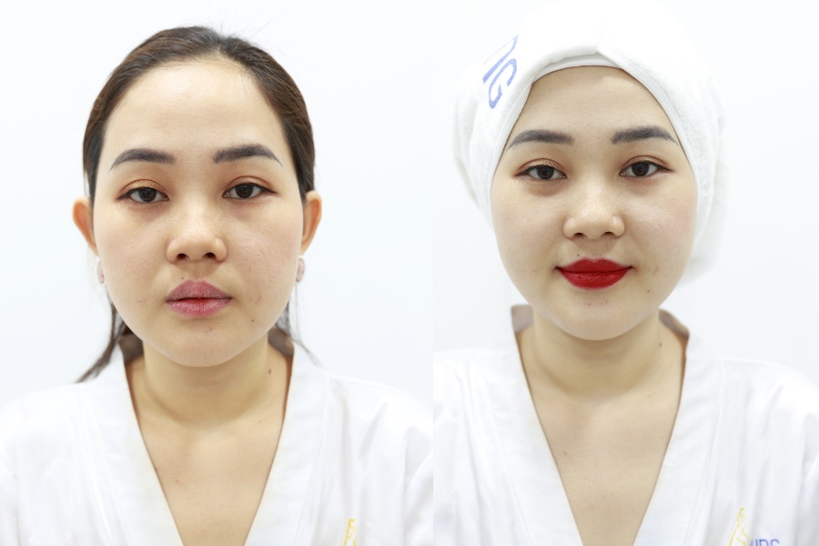 Hình ảnh của chị khách trước và sau khi thực hiện phun môi màu đỏ mận tại Ngọc Dung Beauty Center
