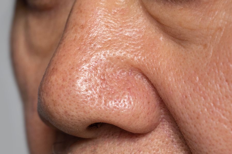 Lỗ chân lông to ở mũi do tình trạng lão hóa