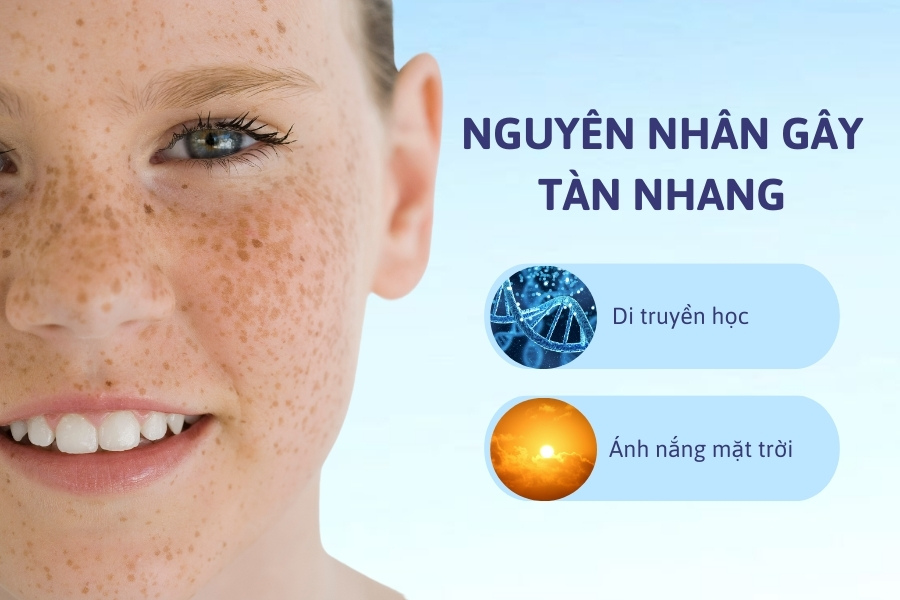 Ánh nắng mặt trời và di truyền là 2 nguyên nhân chính làm xuất hiện tàn nhang Ánh nắng mặt trời và di truyền là 2 nguyên nhân chính làm xuất hiện tàn nhang