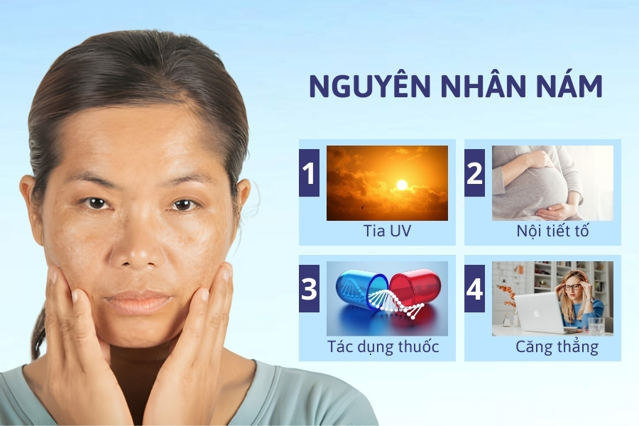 Nguyên nhân gây nám da bao gồm ánh nắng mặt trời, nội tiết tố, tác dụng của thuốc, stress kéo dài Nguyên nhân gây nám da bao gồm ánh nắng mặt trời, nội tiết tố, tác dụng của thuốc, stress kéo dài