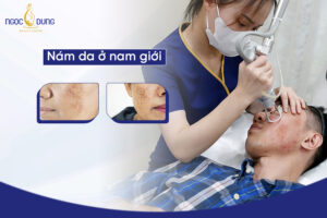 Nám da ở nam giới - Nguyên nhân và cách điều trị hiệu quả