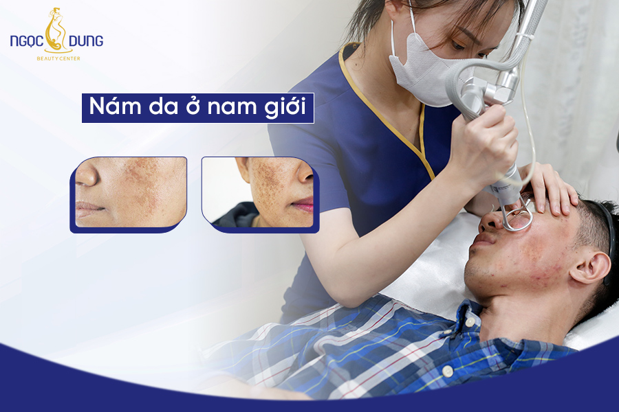 Nám da ở nam giới - Nguyên nhân và cách điều trị hiệu quả