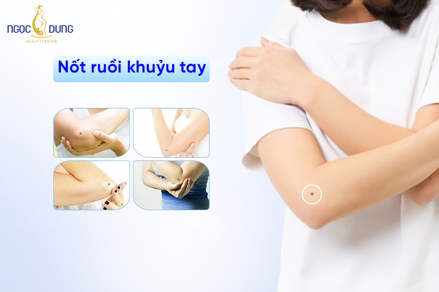 Nốt ruồi ở khuỷu tay - Vượng tài lộc, sự nghiệp hanh thông?