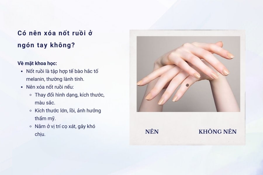 Có nên xóa nốt ruồi ở ngón tay không?