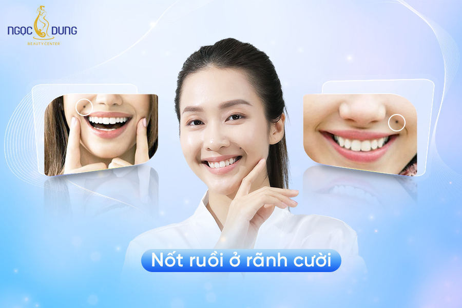 Nốt ruồi ở rãnh cười là tướng quý, tài lộc hay mang vận xui?