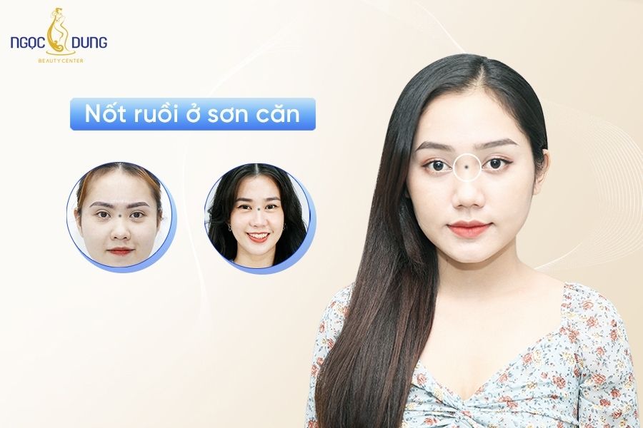 Nốt ruồi ở sơn căn là điềm xấu hay điềm tốt? Cùng chuyên gia Ngọc Dung Beauty tìm hiểu ngay