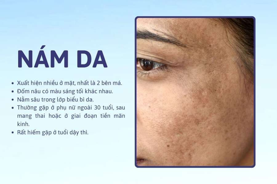 Nám thường dễ nhận biết hơn vì có màu sắc thâm vàng hoặc nâu đậm, kích thước không đồng đều, thường lớn hơn tàn nhang và đồi mồi Nám thường dễ nhận biết hơn vì có màu sắc thâm vàng hoặc nâu đậm, kích thước không đồng đều, thường lớn hơn tàn nhang và đồi mồi