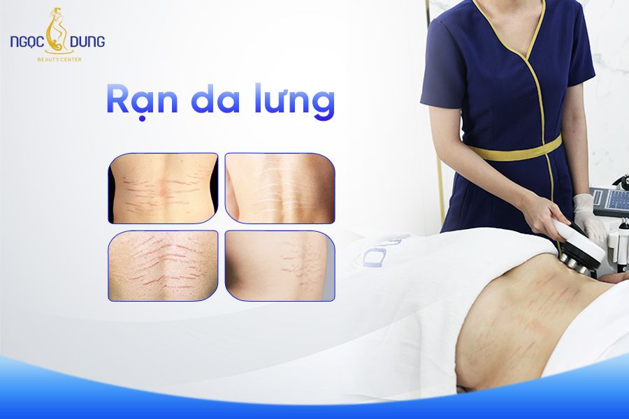 Rạn da lưng khiến nhiều “nàng” trở nên tự ti và luôn tìm mọi cách để khắc phục
