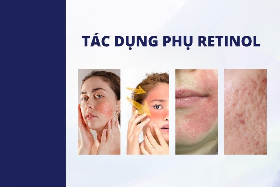 Tác dụng phụ có thể xảy ra khi sử dụng Retinol để trị mụn