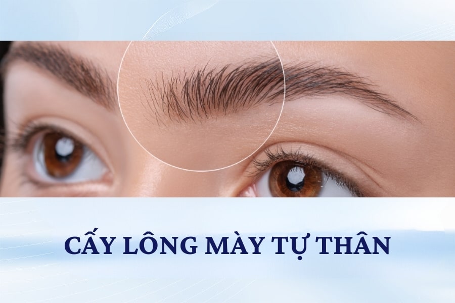 Thực hiện cấy ghép lông mày khi tình trạng rụng lông mày không cải thiện Thực hiện cấy ghép lông mày khi tình trạng rụng lông mày không cải thiện