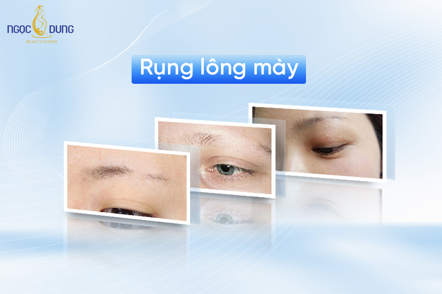 Tại sao lại rụng lông mày? - 9 cách khắc phục lông mày rụng