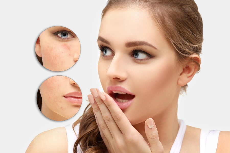 Sẹo mụn có thể xuất hiện do những tổn thương viêm nhiễm trên da sau mụn