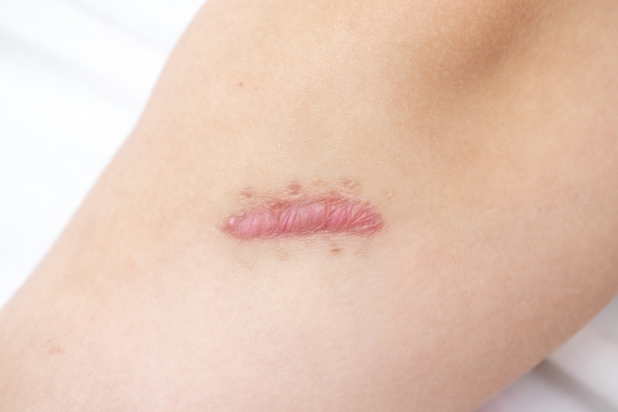 Những người có sẹo lồi kích thước nhỏ, ít hoặc không có tình trạng thâm nặng, và sẹo có màu nhạt nên tiêm sẹo lồi.