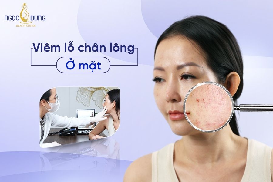 Tổng hợp các cách trị viêm lỗ chân lông ở mặt mà có thể bạn cần biết