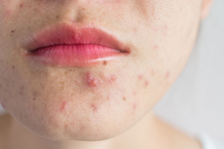 Các dấu hiệu của viêm nang lông ở mặt có thể biến chuyển tùy thuộc vào đặc điểm cá nhân