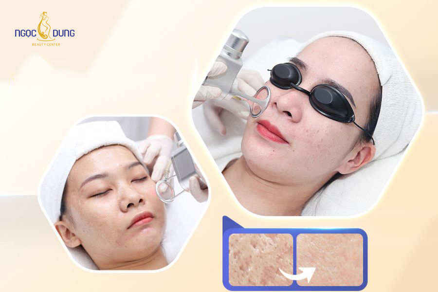 Kết quả sau khi xóa sẹo rỗ do mụn bằng công nghệ Laser tại Thẩm mỹ viện Ngọc Dung