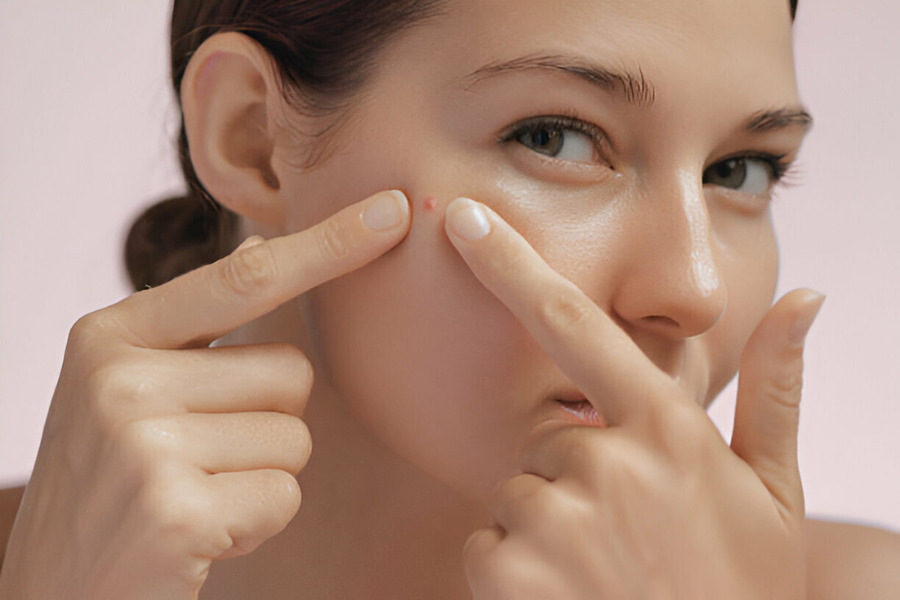 Không nên tự ý nặn mụn khi đến tháng, đặc biệt là khi mụn chưa già Không nên tự ý nặn mụn khi đến tháng, đặc biệt là khi mụn chưa già