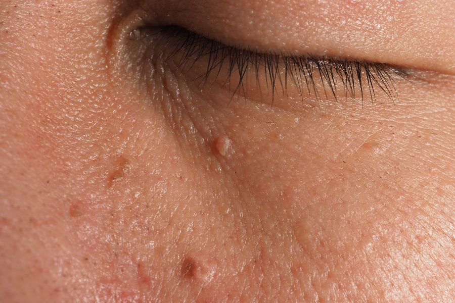 Mụn thịt là một dạng u của tuyến mồ hôi, trong đó chứa nhiều chất sừng Mụn thịt là một dạng u của tuyến mồ hôi, trong đó chứa nhiều chất sừng