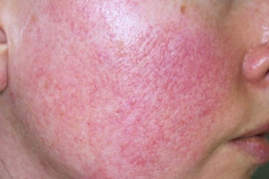 Da nhiễm corticoid