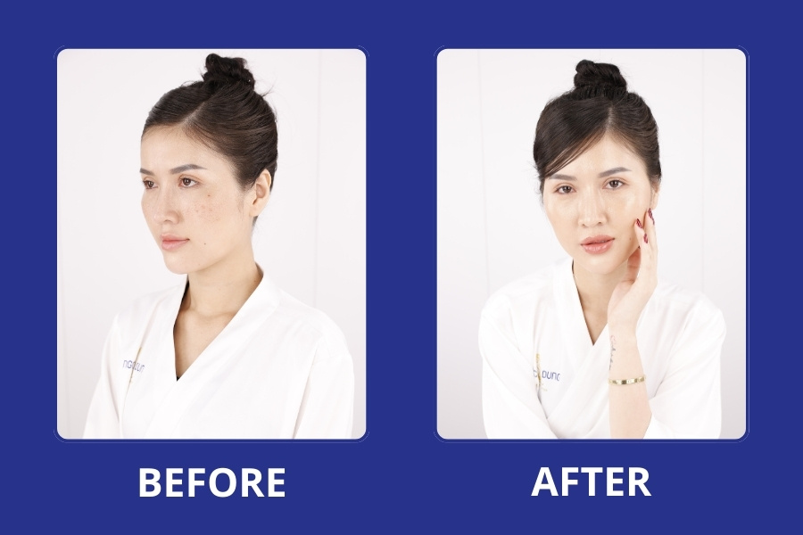 Sở hữu làn da trắng sáng mịn màng, không bóng mụn sau khi điều trị tại Ngọc Dung Sở hữu làn da trắng sáng mịn màng, không bóng mụn sau khi điều trị tại Ngọc Dung