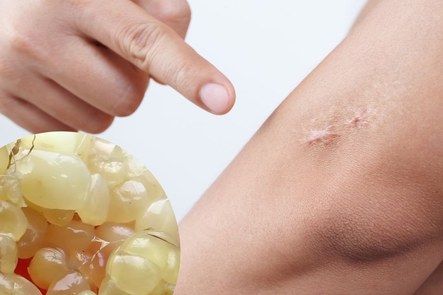 Omega 3 và vitamin có trong mỡ trăn giúp kích thích sản sinh tế bào mới, làm mờ sẹo nhanh chóng trị sẹo bằng mỡ trăn