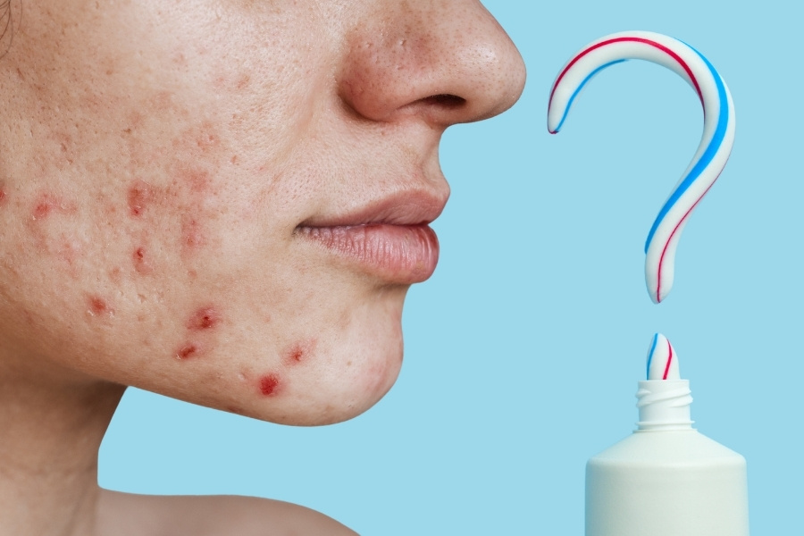 Bôi kem đánh răng lên mụn không những không giúp giảm mụn mà còn gây kích ứng da Bôi kem đánh răng lên mụn không những không giúp giảm mụn mà còn gây kích ứng da