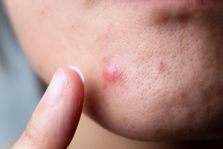 Nên bôi kem trị mụn trước để hoạt chất trong kem phát huy hiệu quả mạnh hơn